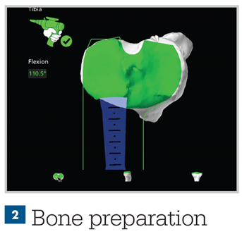 Infographic - Mako Technology - Bone Preperation